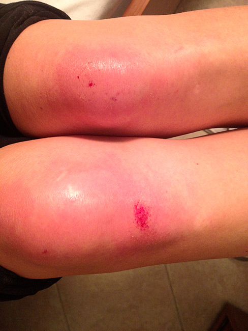 Bruised Knees