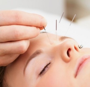 Acupuncture For Headaches